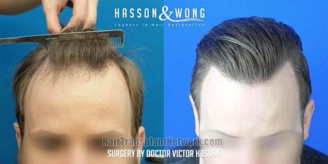 Before and after hair restoration procedure images