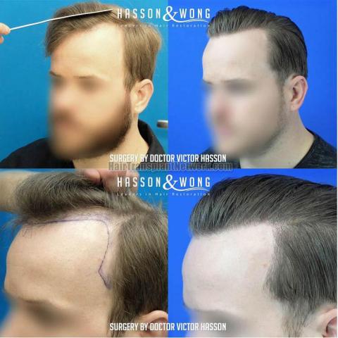  before and after result photographs