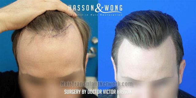 Top view - Before and after hair restoration procedure