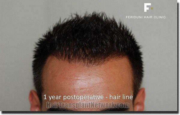 Hair restoration procedure results