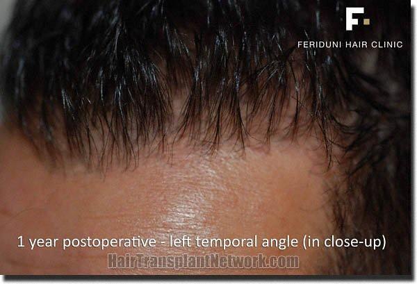 Hair restoration procedure results