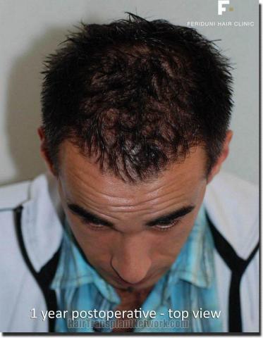 Hair restoration procedure results