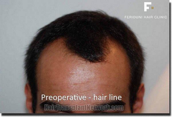 Hair restoration procedure results