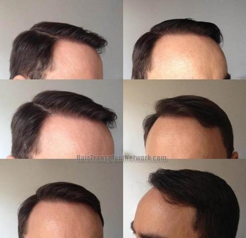 Hair restoration procedure before and after pictures