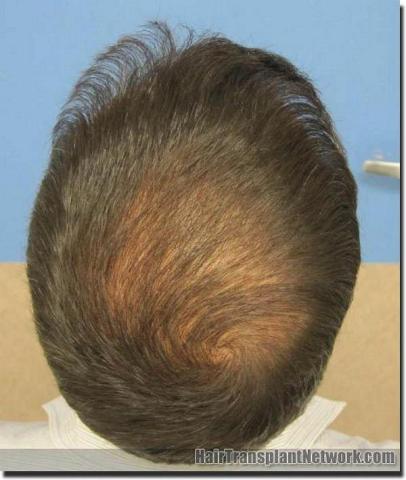 Hair restoration procedure results