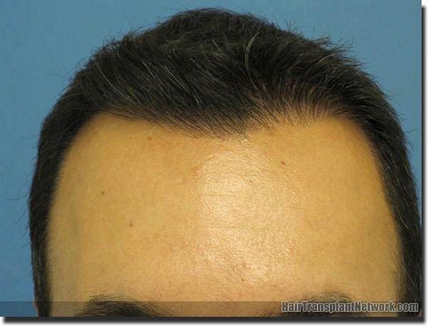 Hair restoration procedure results