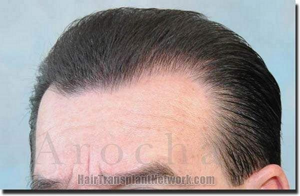 Hair restoration procedure results