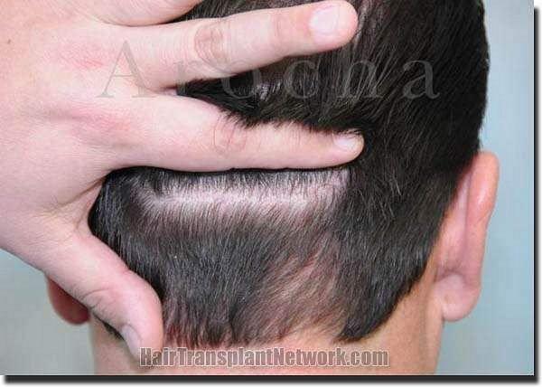 Hair restoration procedure results