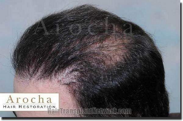 Hair restoration procedure results