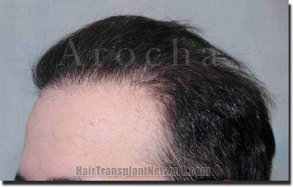 Hair restoration procedure results