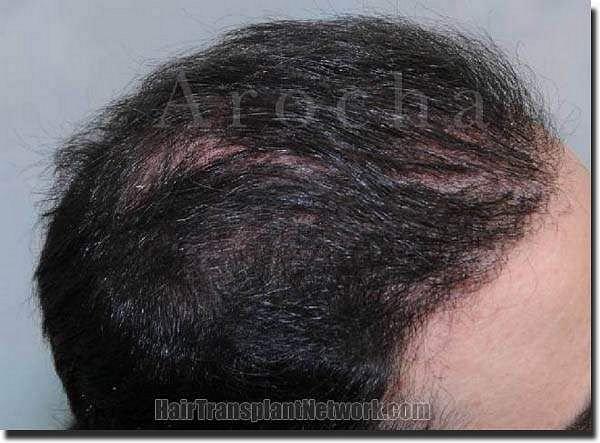 Hair restoration procedure results