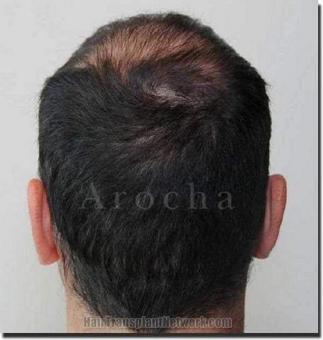 Hair restoration procedure results