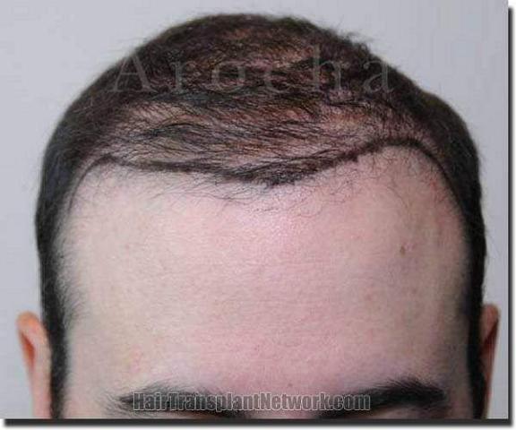 Hair restoration procedure results