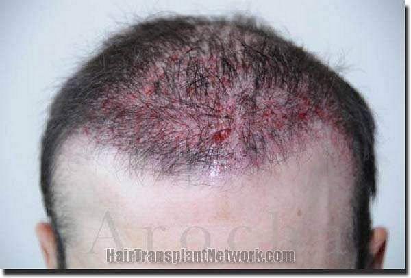 Hair restoration procedure results