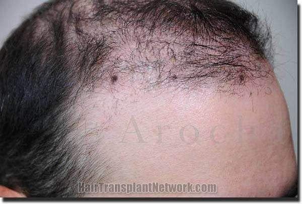 Hair restoration procedure results