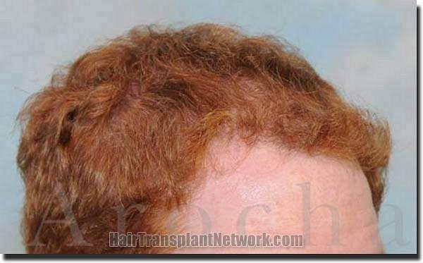 Hair restoration procedure results