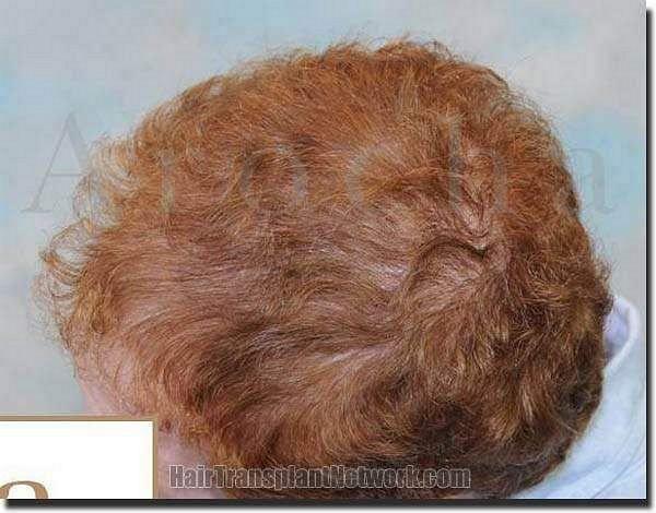 Hair restoration procedure results