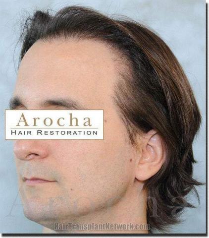 Hair restoration procedure results