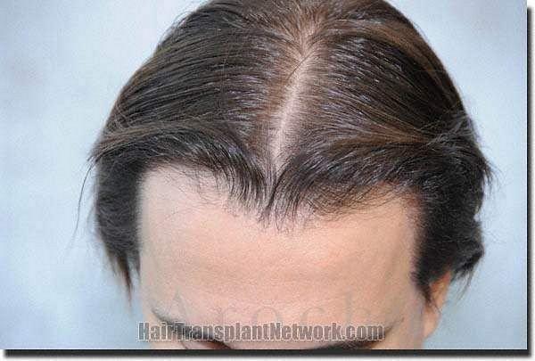 Hair restoration procedure results