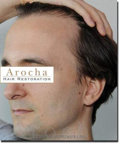 Hair restoration procedure results