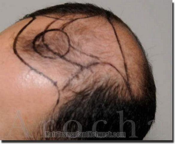 Hair restoration procedure results