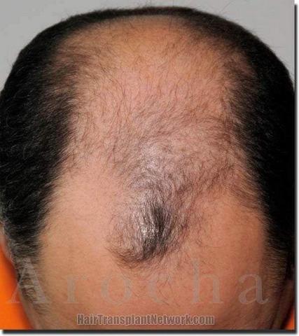 Hair restoration procedure results