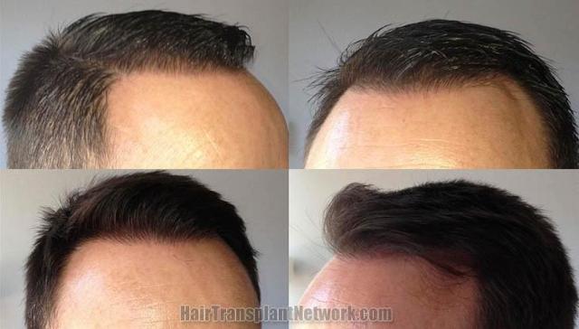 Hair transplantation surgery before and after images