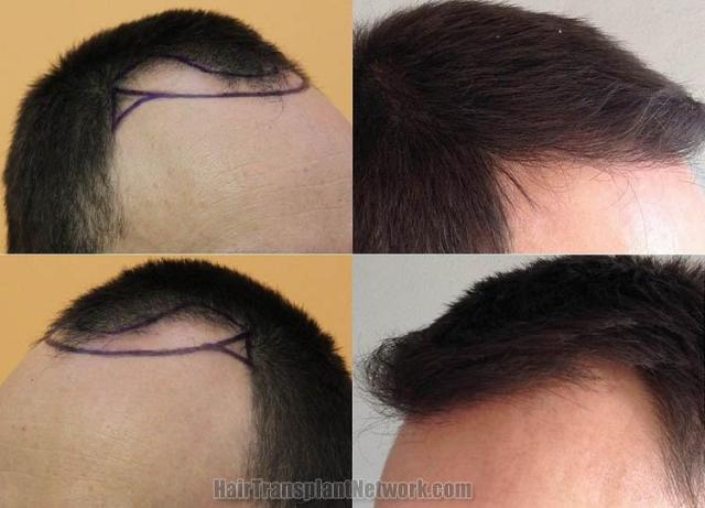 Hair transplantation surgery before and after pictures