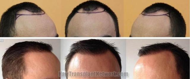 Hair restoration procedure before and after results