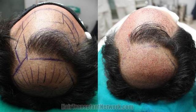 Hair transplantation surgery before and after pictures