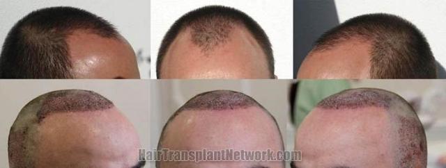 Hair restoration procedure before and after results