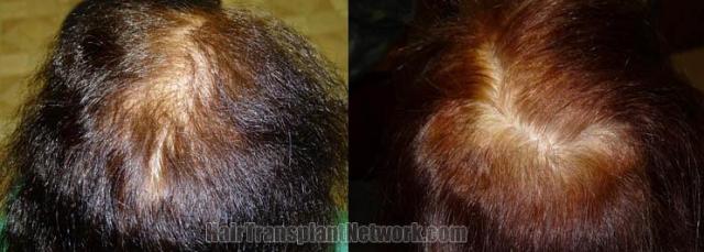 Crown view before and after hair restoration images