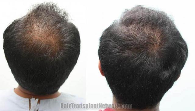 Hair restoration procedure before and after pictures