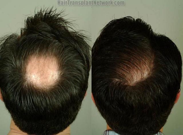 Hair transplantation procedure before and after photographs