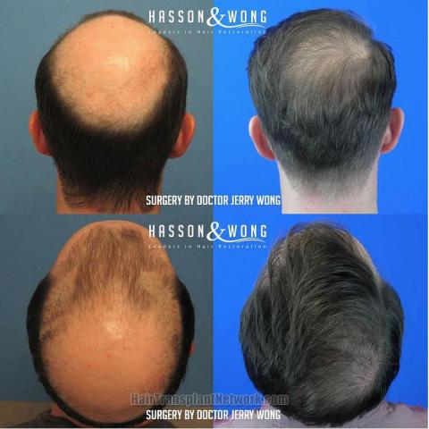 Surgical hair transplantation result photographs