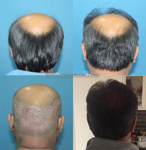 Surgical hair transplantation result photographs