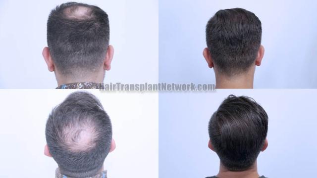 Surgical hair transplantation result photographs