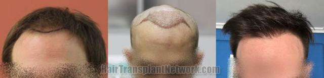 Hair restoration procedure before and after results