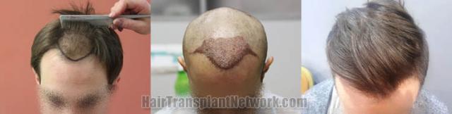 Hair restoration procedure before and after results