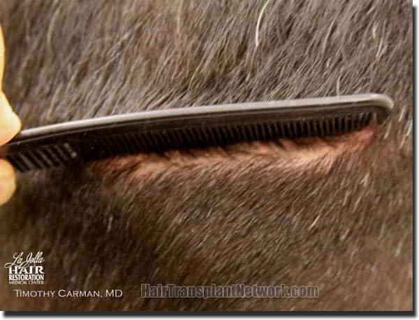 Hair restoration procedure results