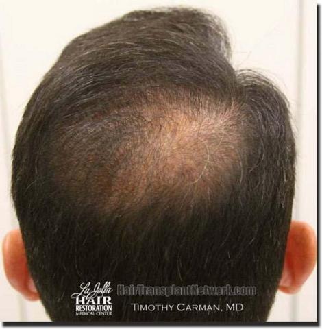 Hair restoration procedure results