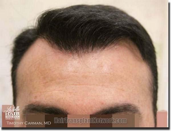 Hair restoration procedure results