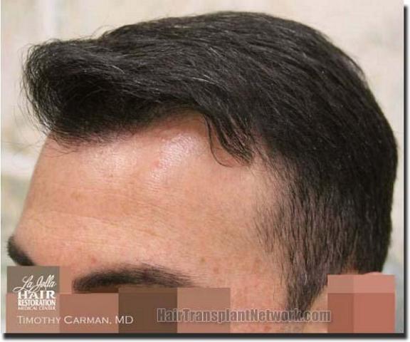 Hair restoration procedure results