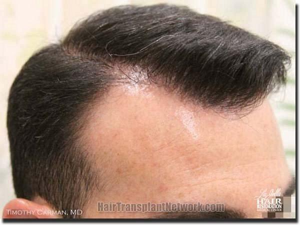 Hair restoration procedure results