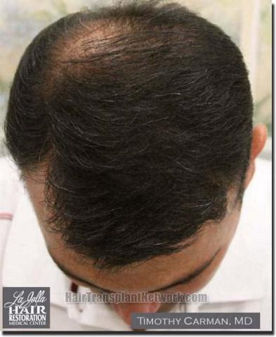 Hair restoration procedure results