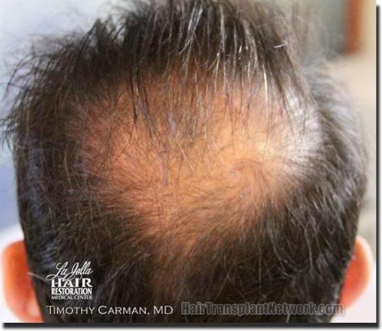 Hair restoration procedure results