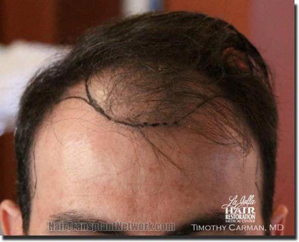 Hair restoration procedure results