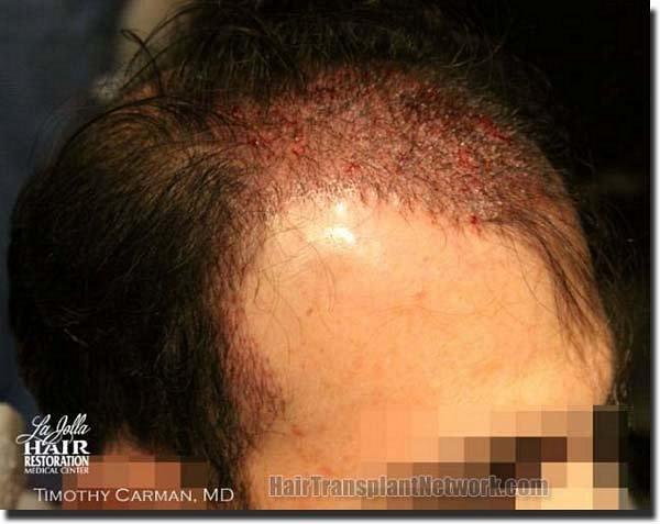 Hair restoration procedure results