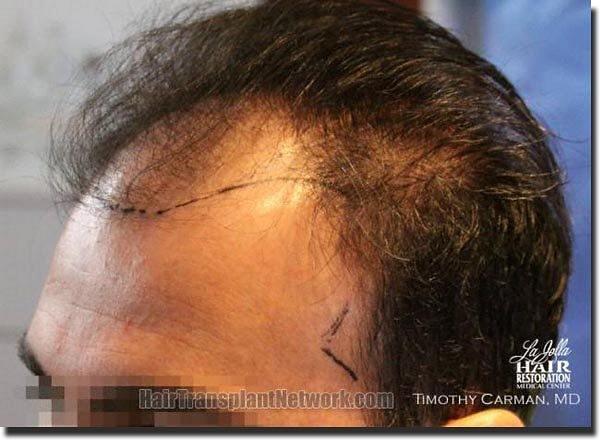 Hair restoration procedure results