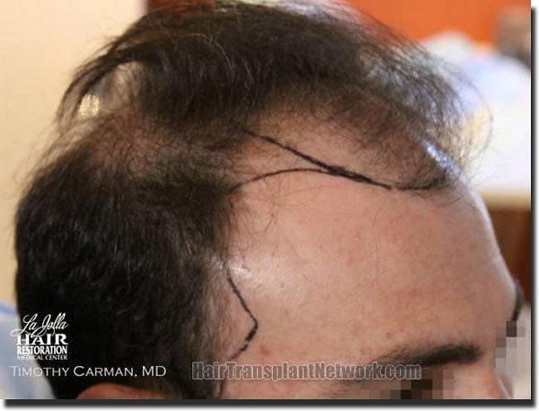 Hair restoration procedure results